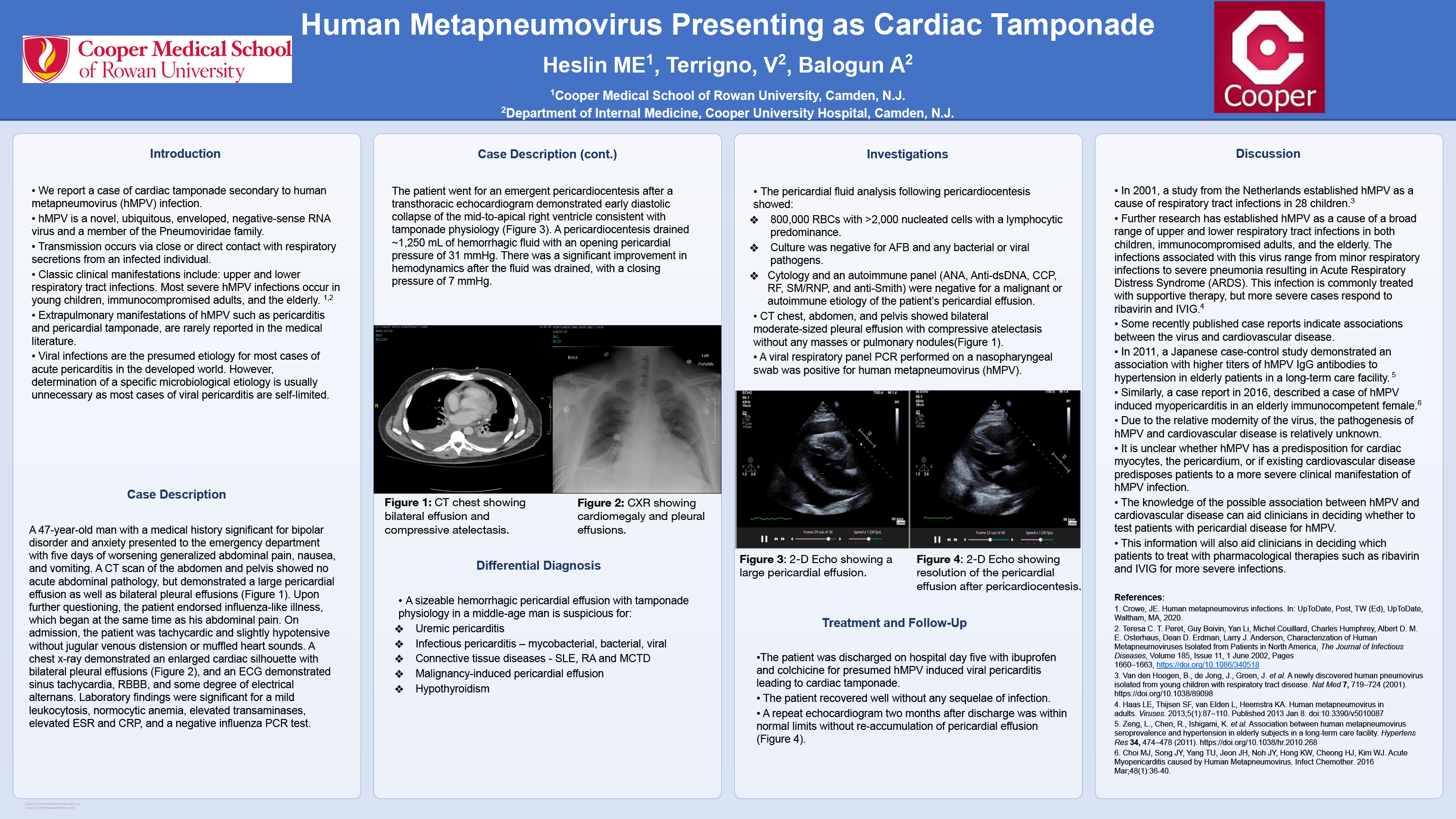 12-CV-4-Human Metapneumovirus presenting as cardiac tamponade in a 47-year-old immunocompetent male