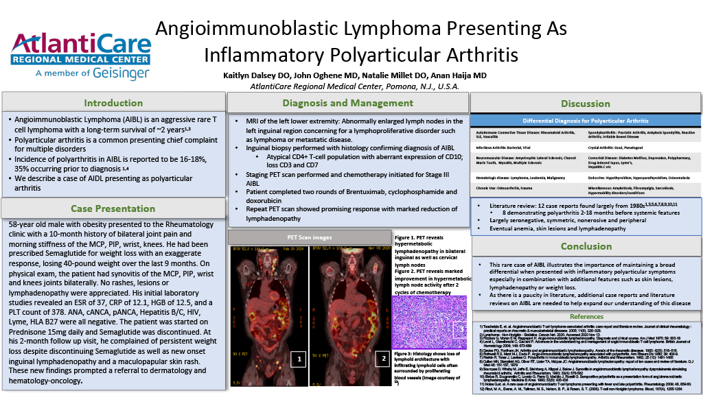 13-CV-17-Angioimmunoblastic Lymphoma presenting as Inflammatory Polyarticular Arthritis