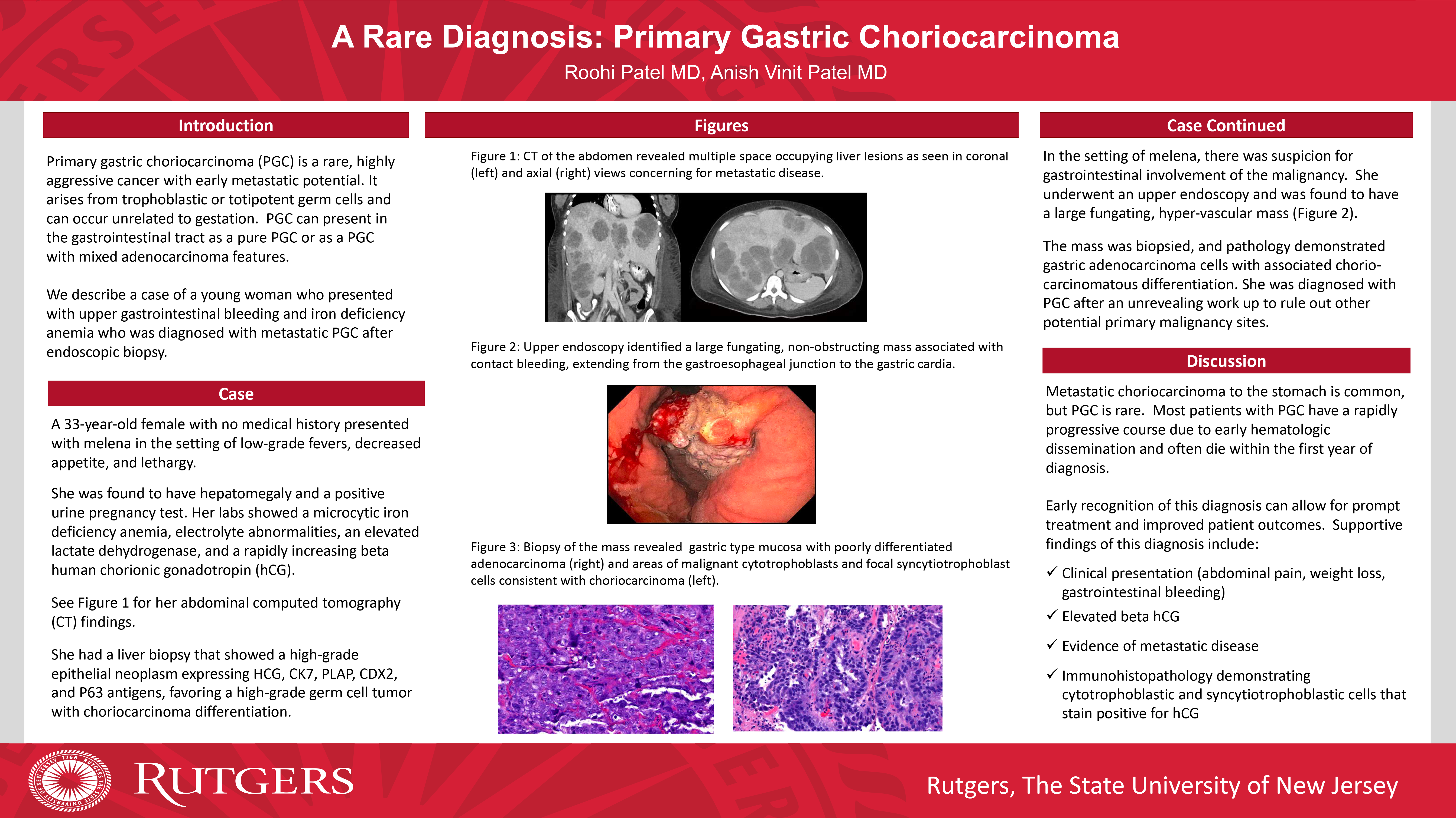 14-CV-18-A Rare Diagnosis- Primary Gastric Choriocarcinoma