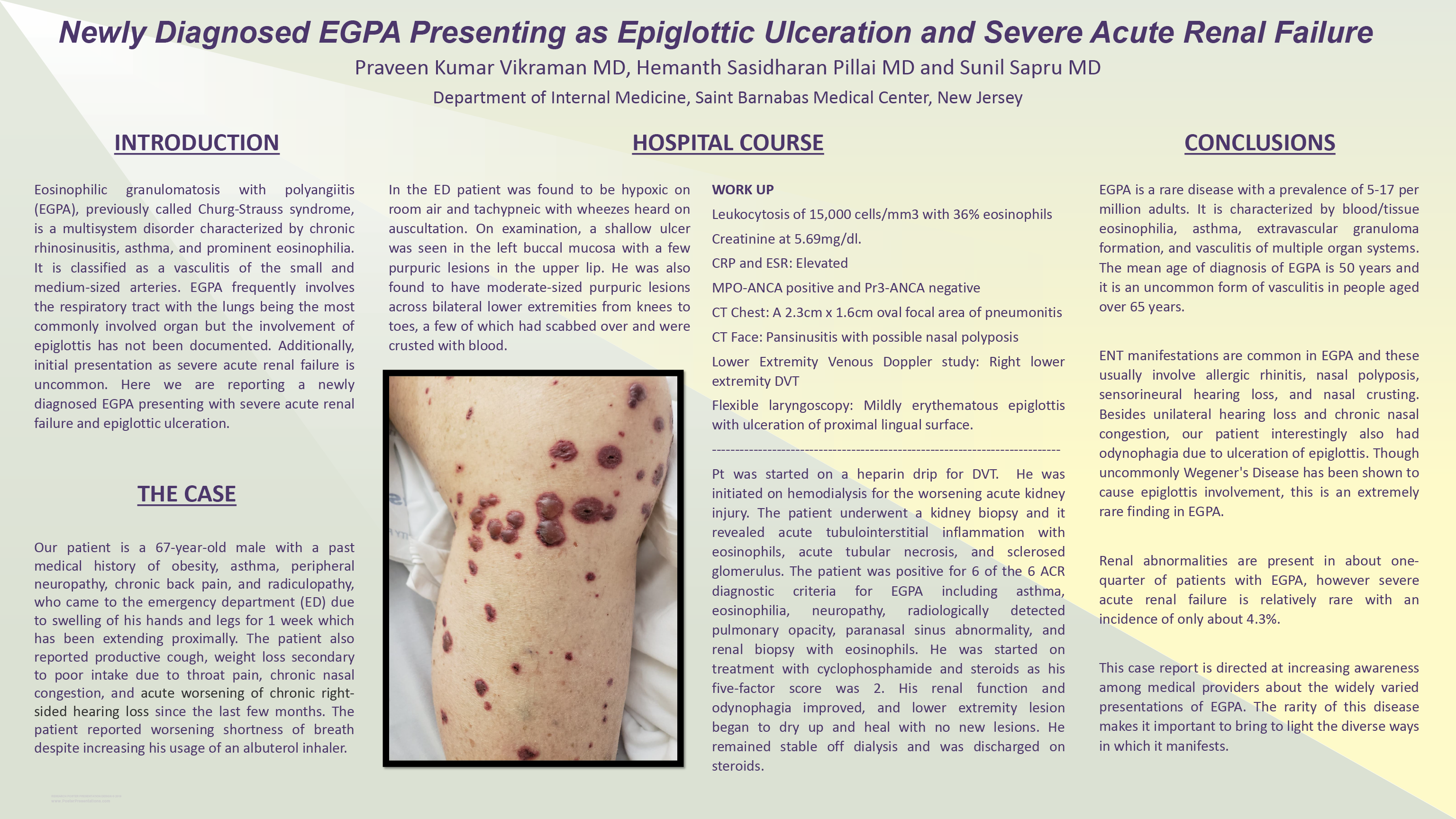 15-CV-21-Newly Diagnosed EGPA Presenting as Epiglottic Ulceration and Severe Acute Renal Failure