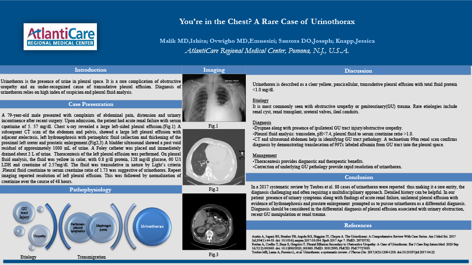 16-CV-29-Youre in the Chest A Rare Case of Urinothorax