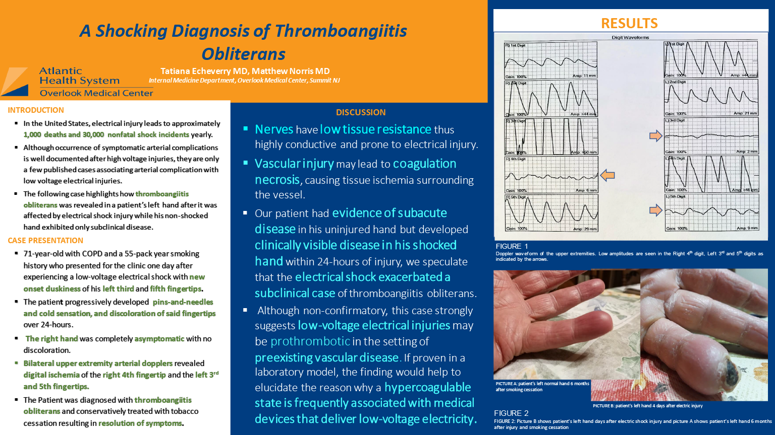 18-CV-38-AA Shocking Diagnosis of Thromboangiitis Obliterans after Electrical Injury