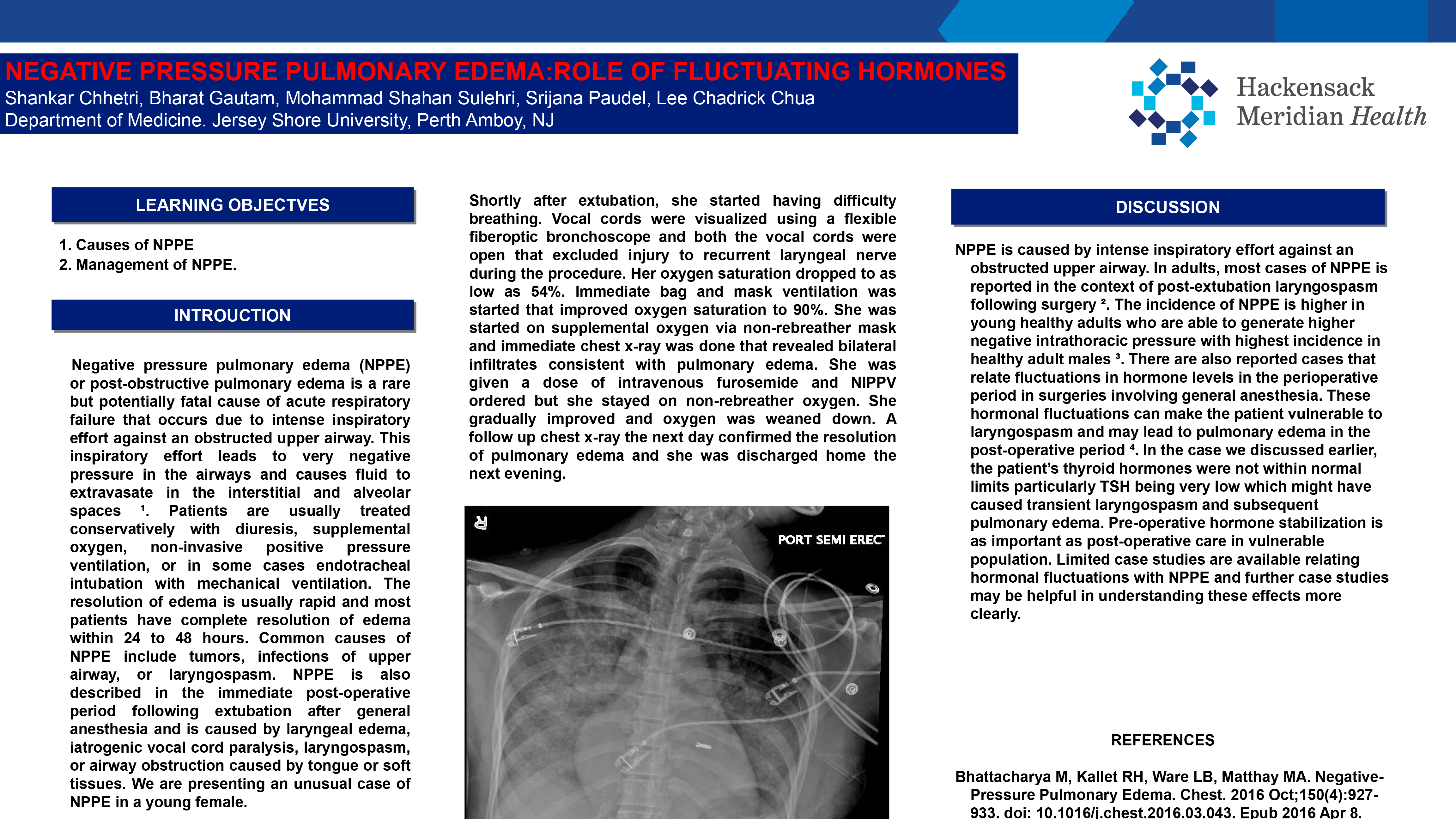 37-CV-150-Negative pressure pulmonary edema Role of fluctuating hormones